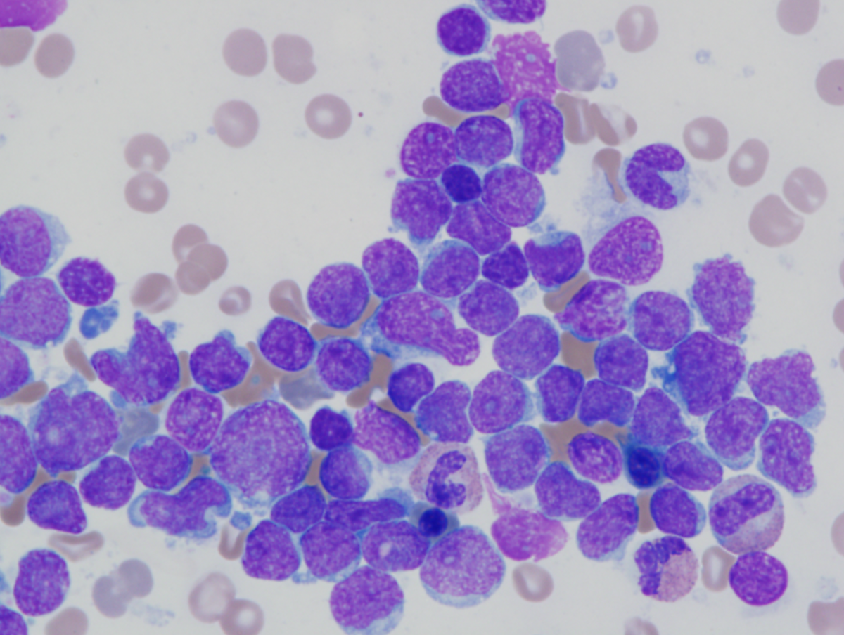 Figure 2: Bone marrow aspirate smear with increased blasts (1000x magnification).